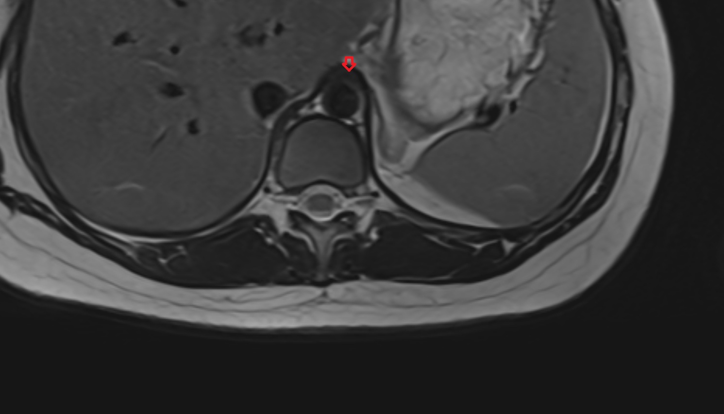 Median arcuate ligament  MRI axial  image anatomy  image -img-00000-00000