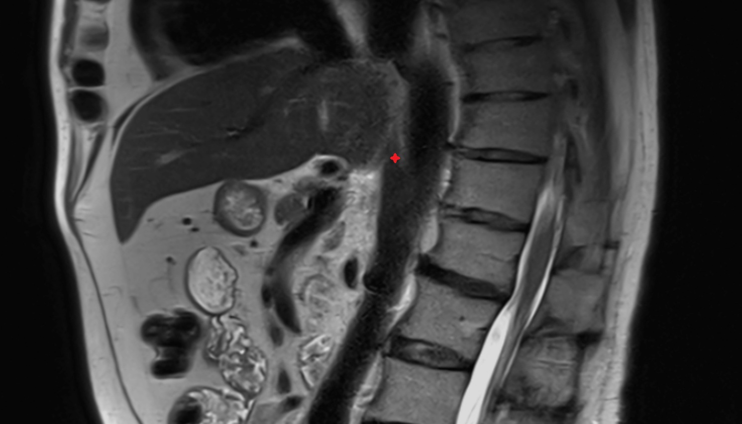 Median arcuate ligament  MRI sag  image anatomy  image -img-00000-00000