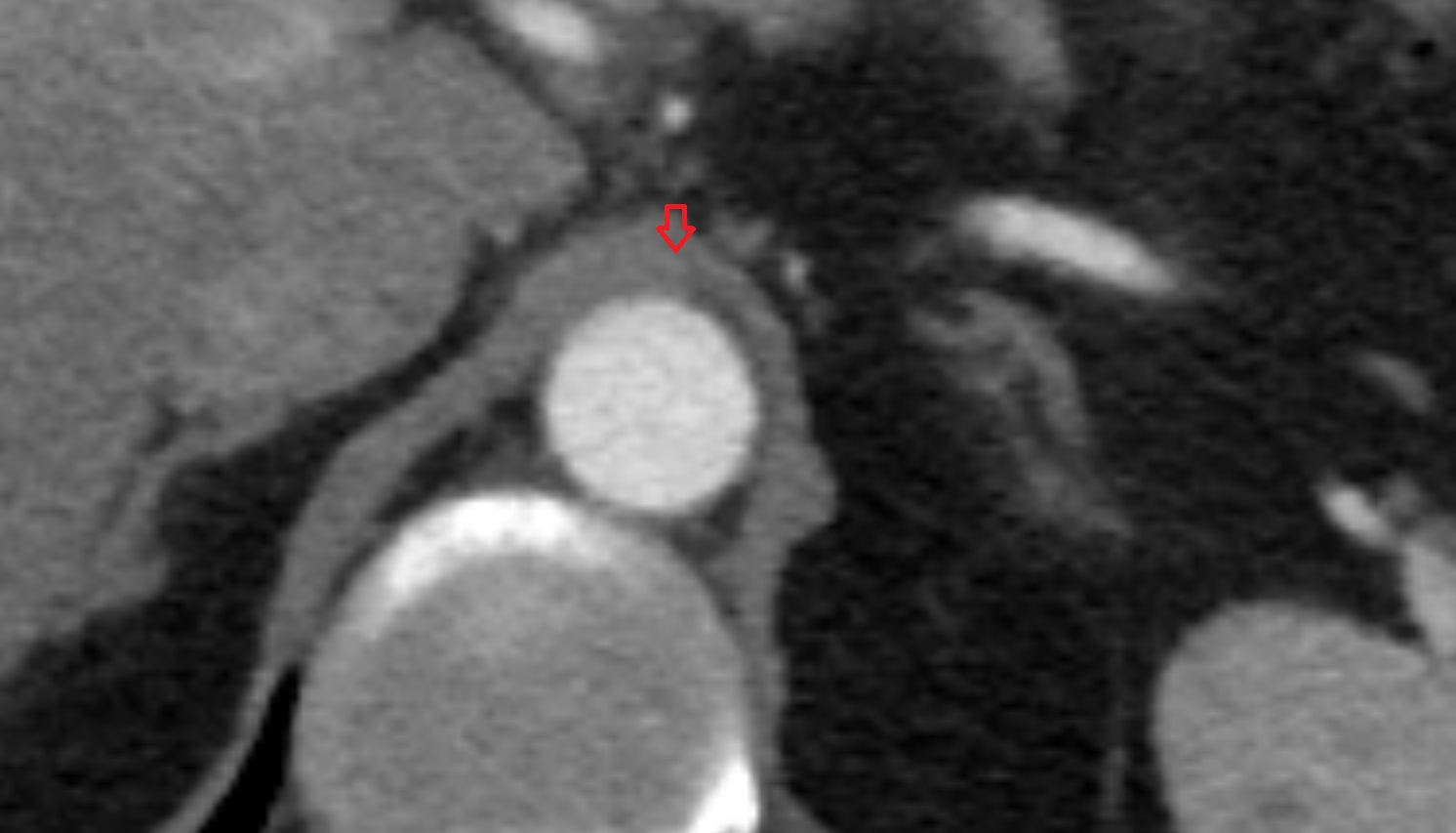 Median arcuate ligament  anatomy CT axial image -img-00000-00000