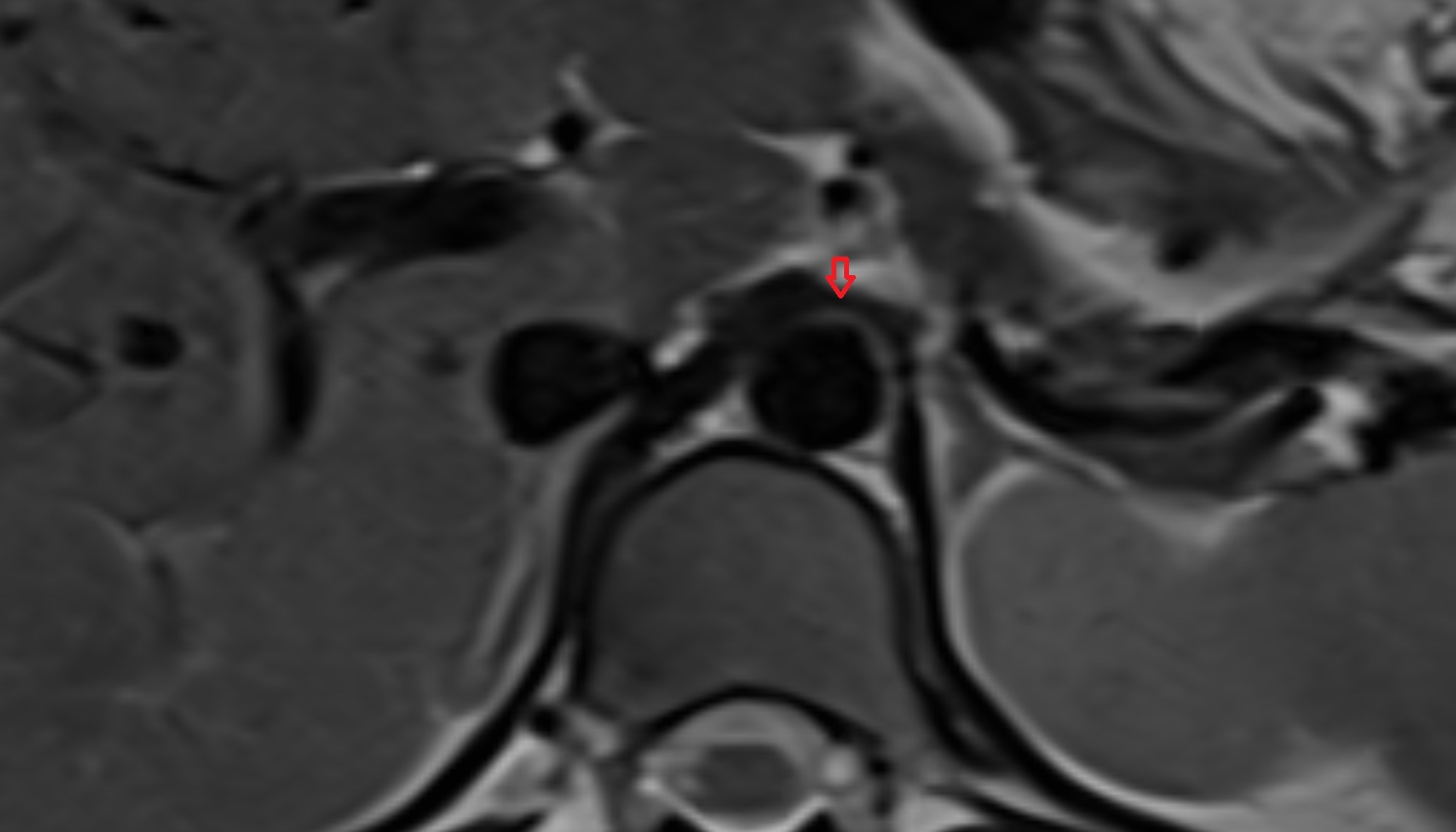 Median arcuate ligament  anatomy MRI  axial image -img-00000-00000
