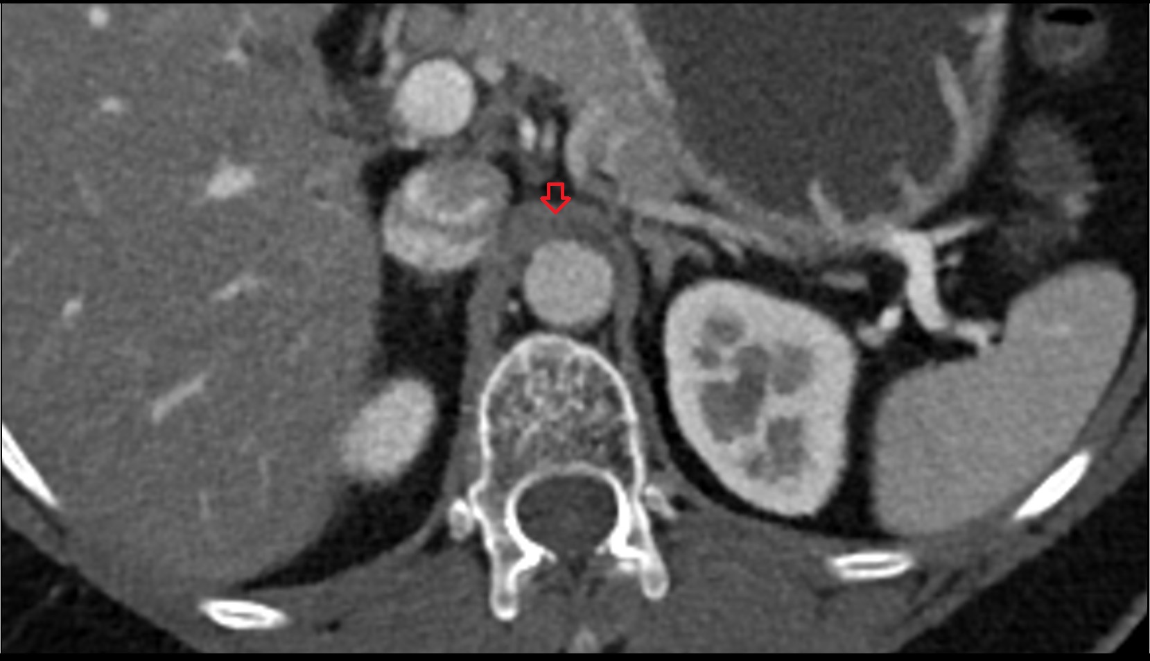 Median arcuate ligament ct axial image