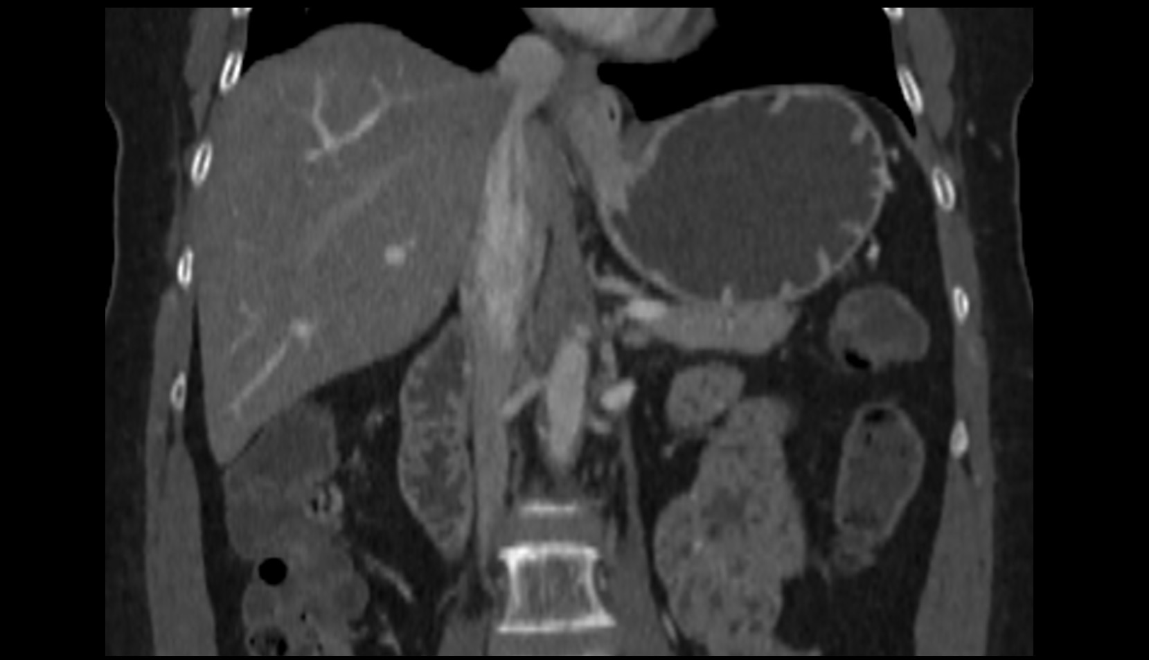 Median arcuate ligament ct coronal image
