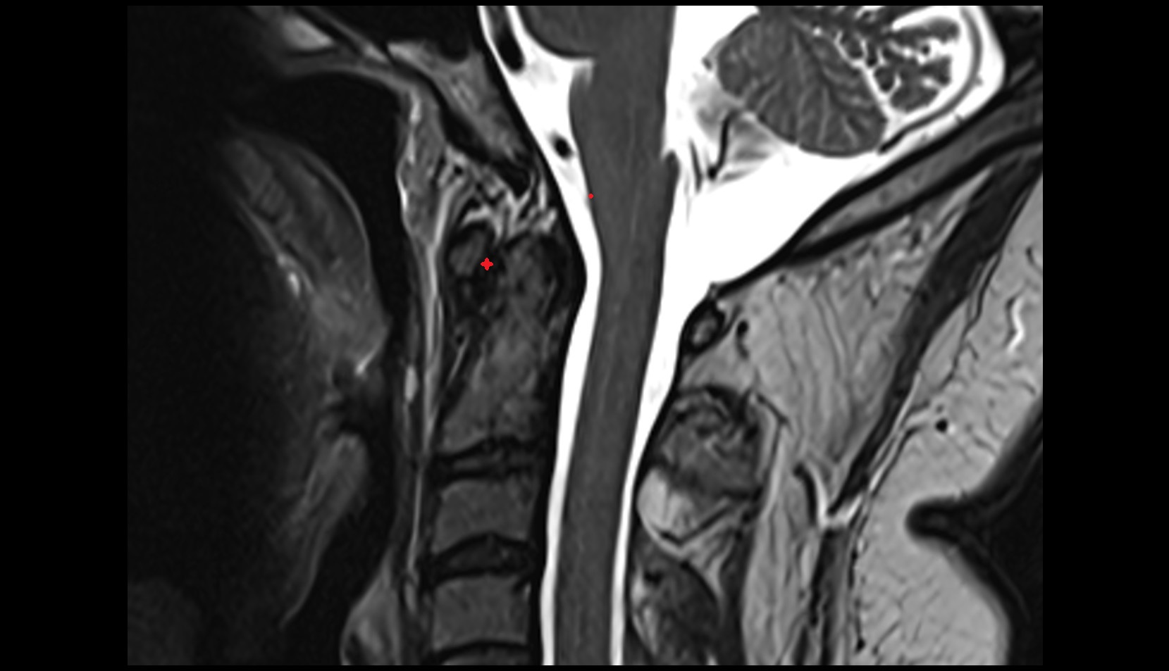 Median atlantoaxial joint