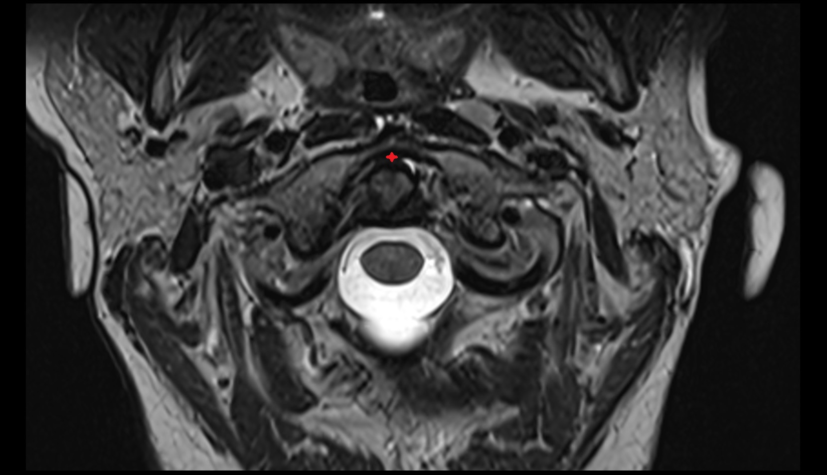 Median atlantoaxial joint axial