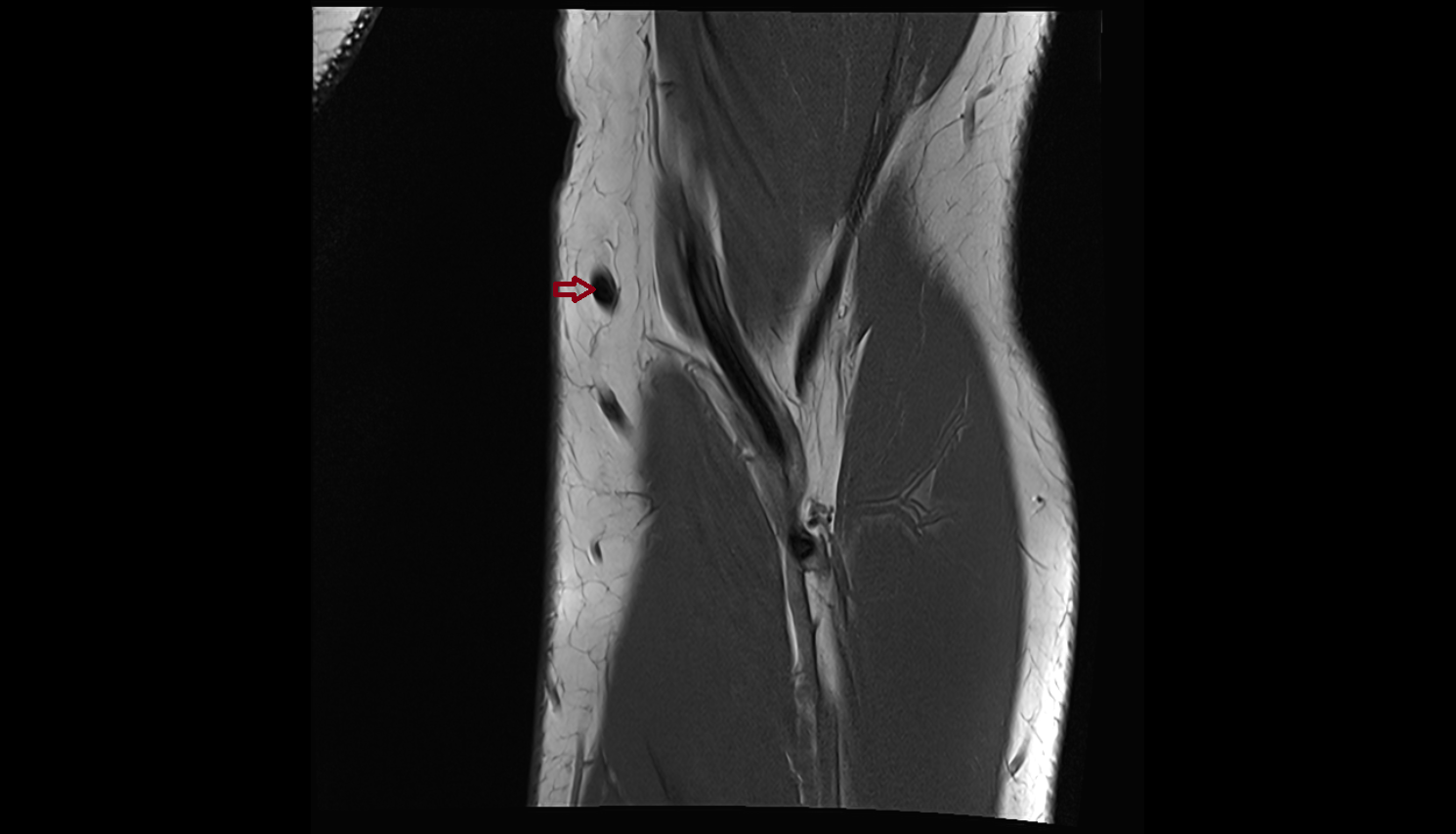 Median cubital vein coronal cross sectional anatomy 3T MRI AI enhanced radiology image -img-00000-00000_00001