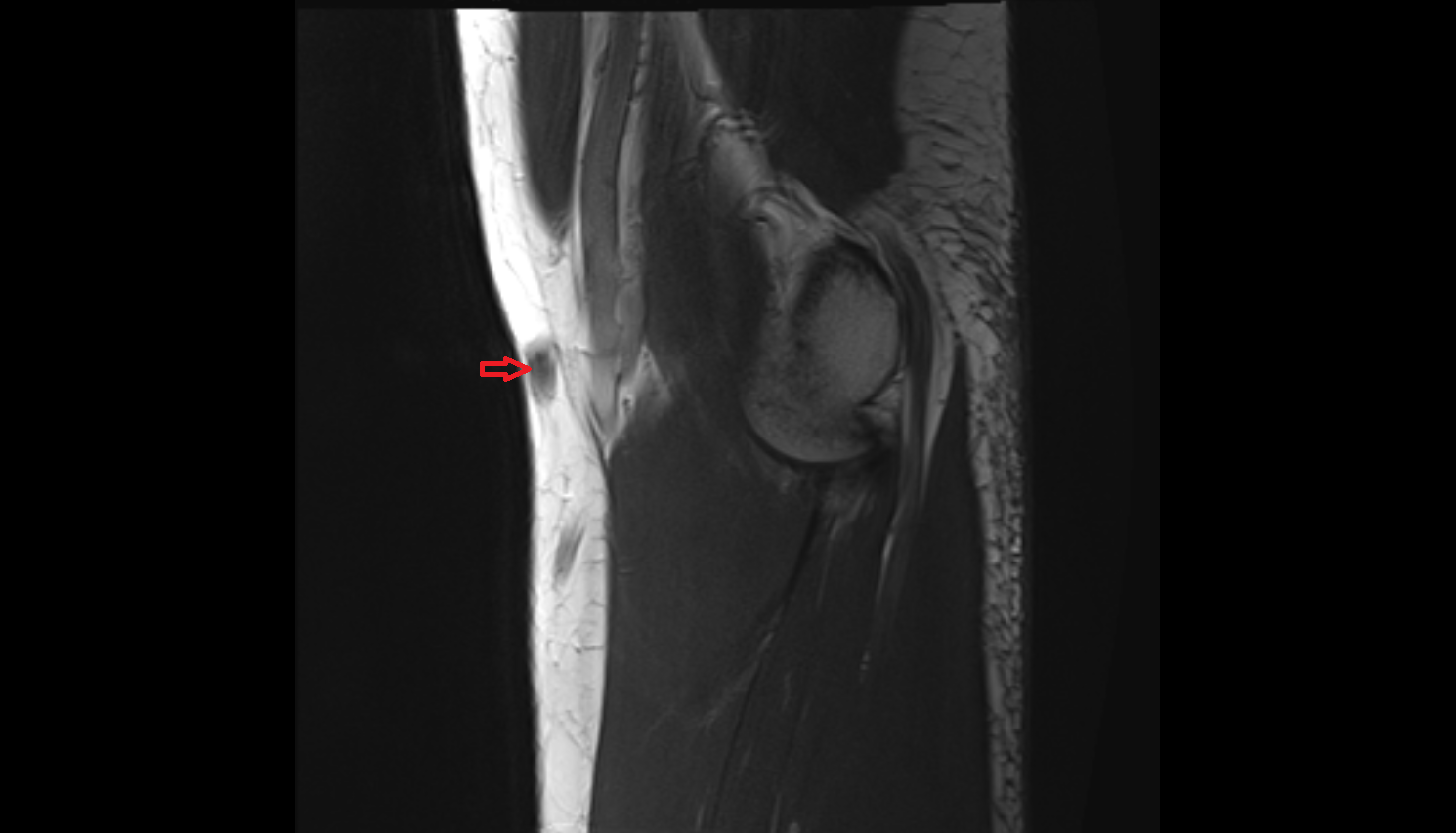 Median cubital vein sag cross sectional anatomy 3T MRI AI enhanced radiology image -img-00000-00000