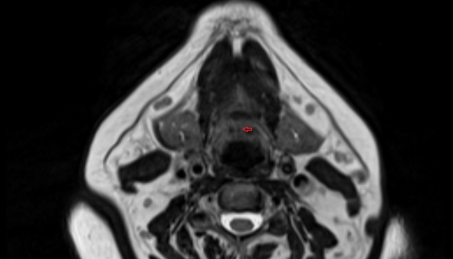 Median glossoepiglottic fold-img-00000-00000