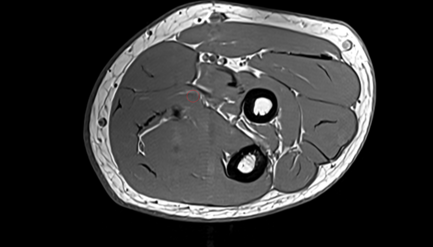 Median nerve axial cross sectional anatomy 3T MRI AI enhanced radiology image-img-00000-00000
