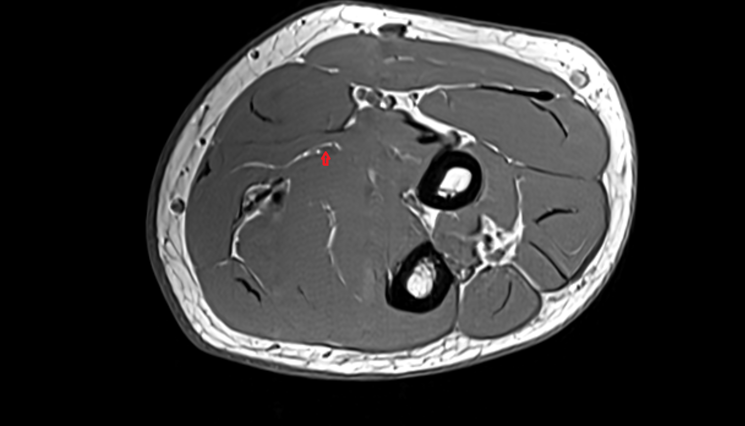 Median nerve axial cross sectional anatomy 3T MRI AI enhanced radiology image-img-00000-00000_00001