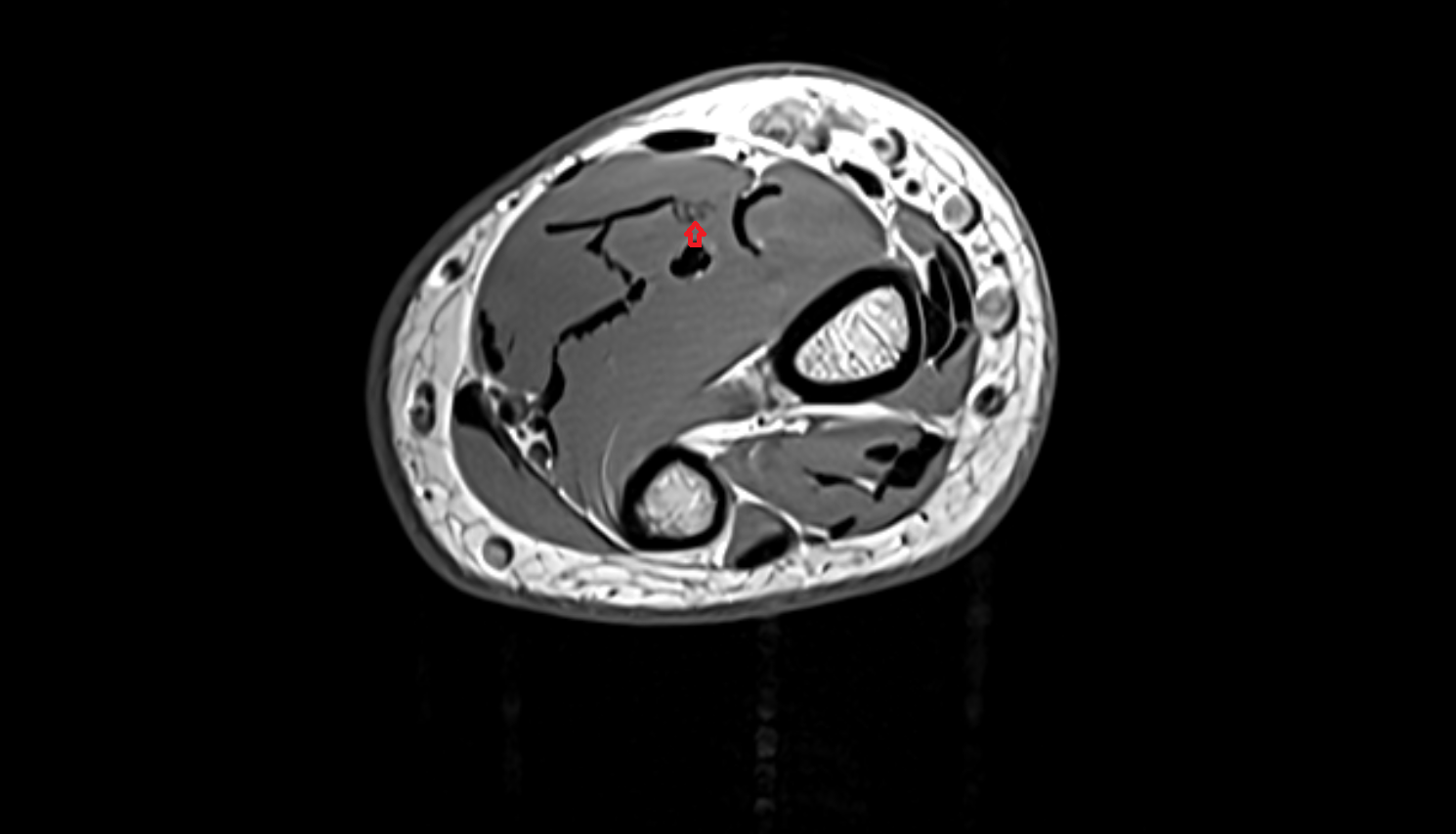 Median nerve axial cross sectional anatomy 3T MRI AI enhanced radiology image-img-00000-00000_00003