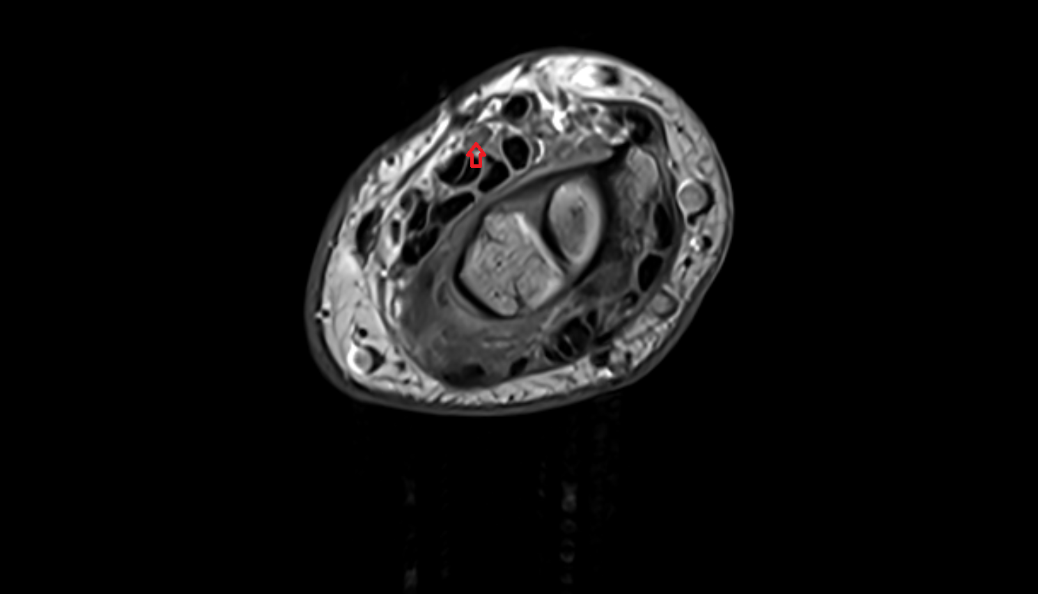 Median nerve  axial cross sectional anatomy 3T MRI AI enhanced radiology image -img-00000-00000_00004