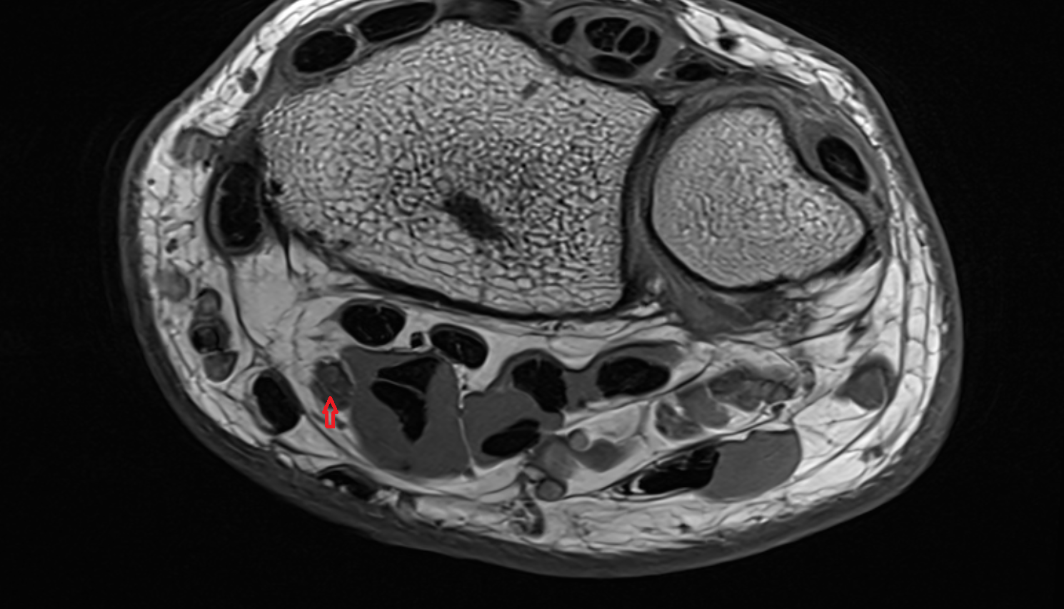 Median nerve axial wrist cross sectional anatomy 3T MRI AI enhanced radiology image-img-00000-00000
