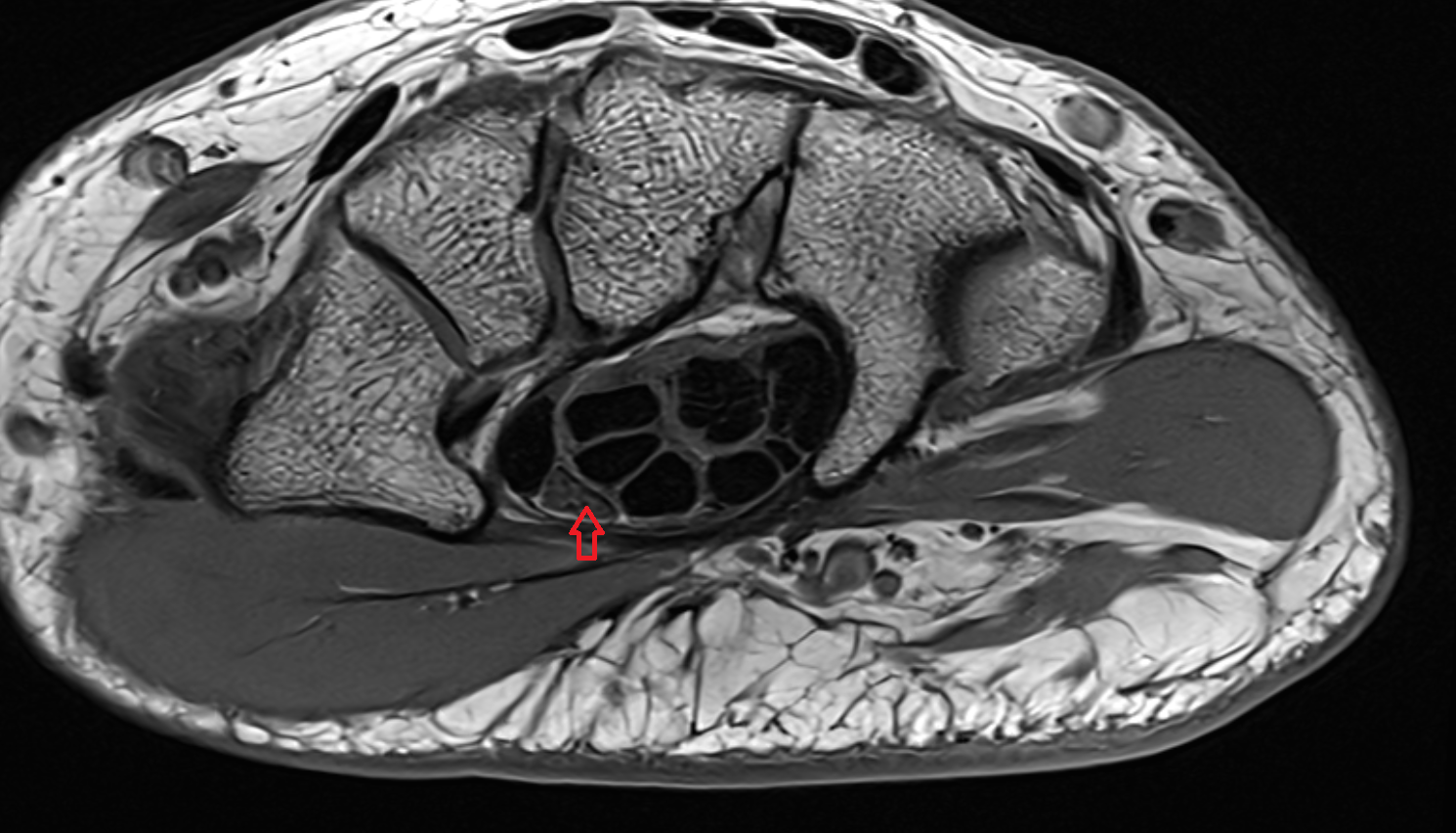 Median nerve axial wrist cross sectional anatomy 3T MRI AI enhanced radiology image-img-00000-00000_00001