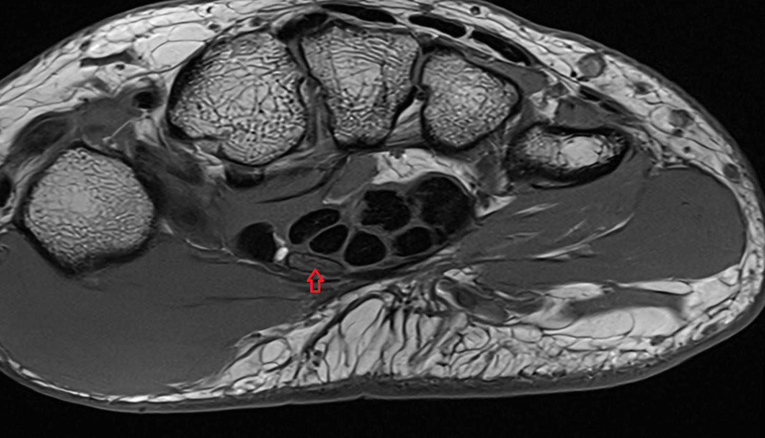 Median nerve axial wrist cross sectional anatomy 3T MRI AI enhanced radiology image-img-00000-00000_00002