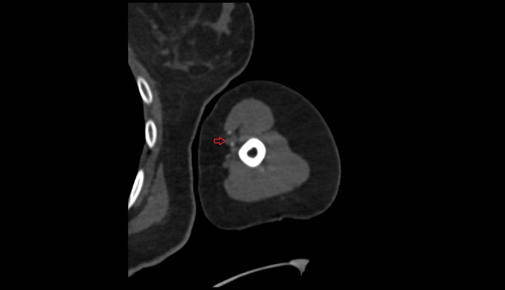 Median nerve ct axial image