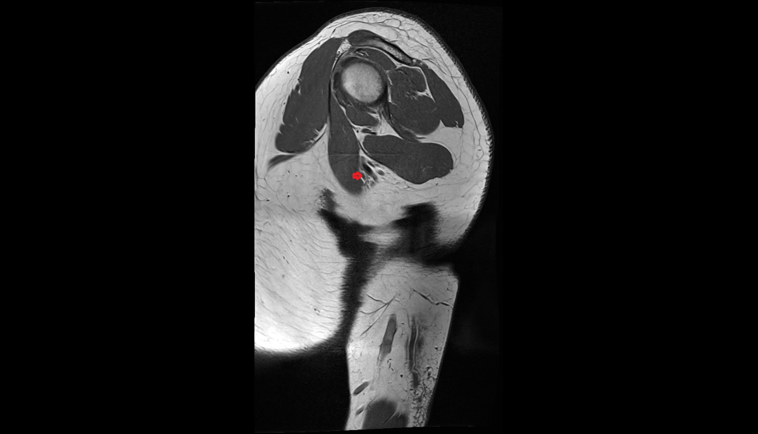 Median nerve sag cross sectional anatomy 3T MRI AI enhanced radiology image-img-00000-00000
