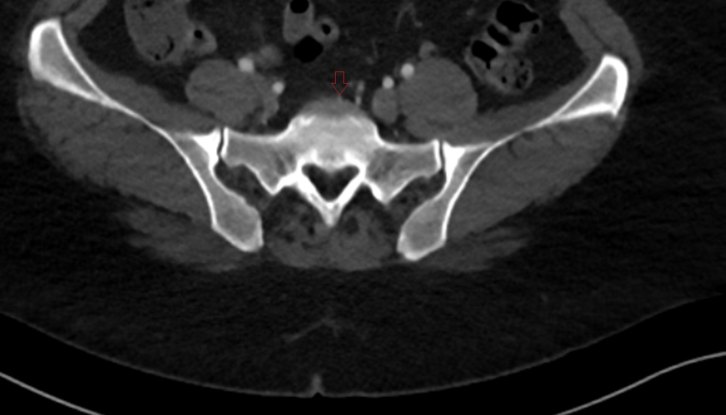Median sacral vein ct axial  anatomy  image-img-00000-00000