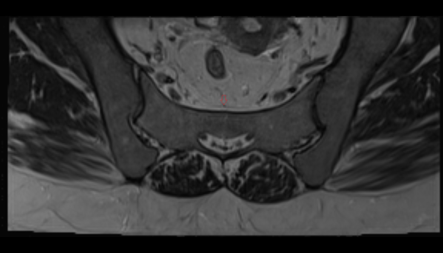 Median sacral vein mri axial  anatomy  image-img-00000-00000