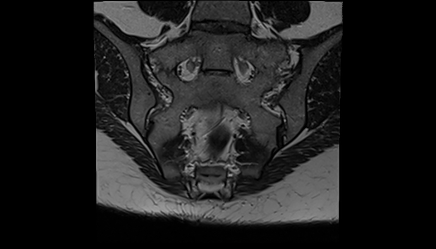 Median sacral vein mri coronal  anatomy  image-img-00000-00000