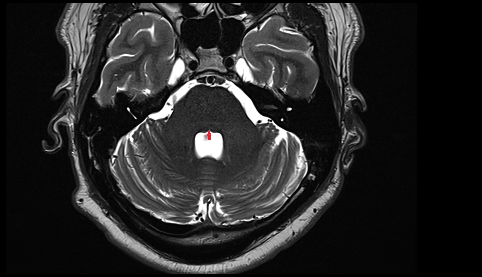 Median sulcus MRI 3T axial image