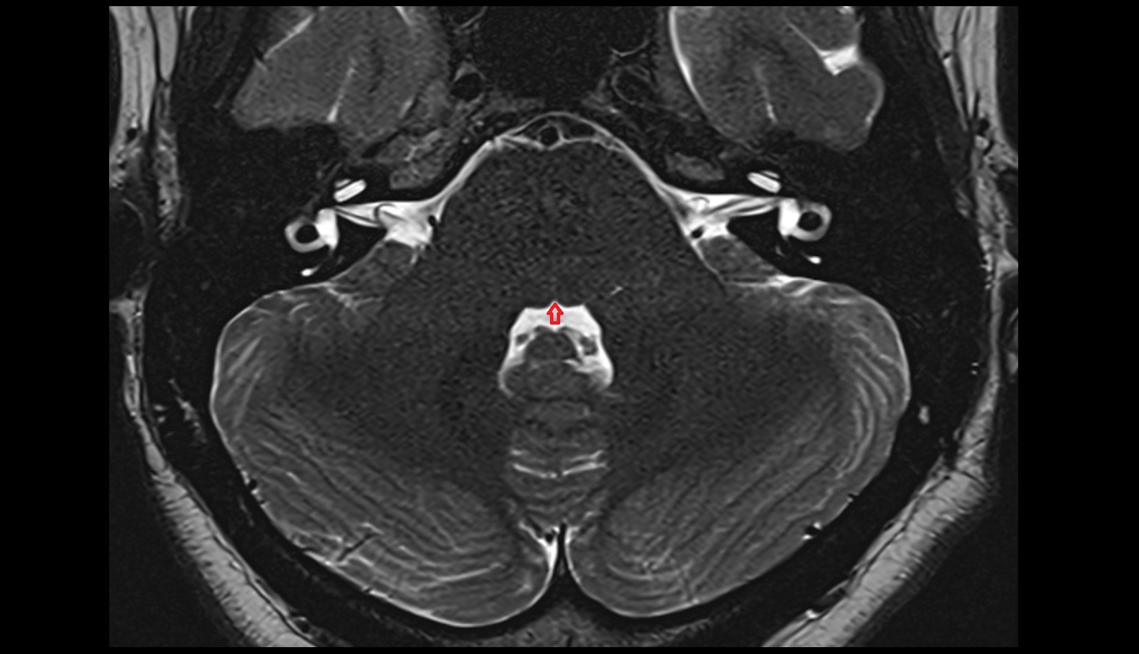 Median sulcus of rhomboid fossa mri axial image