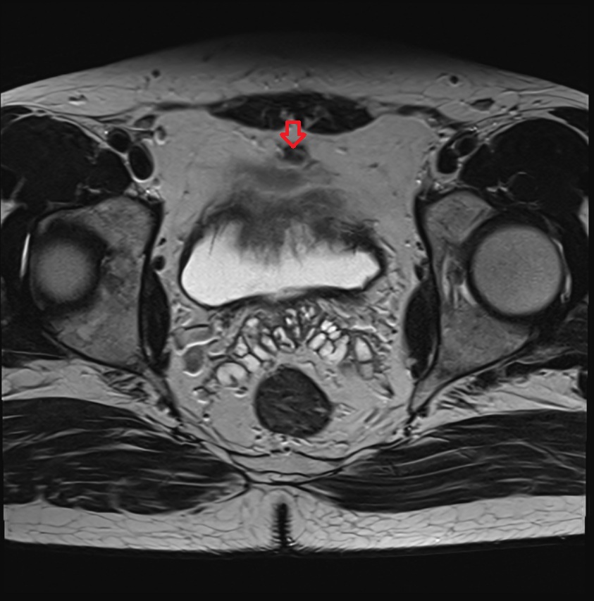 Median umbilical ligament  MRI  axial  anatomy  image-img-00000-00000