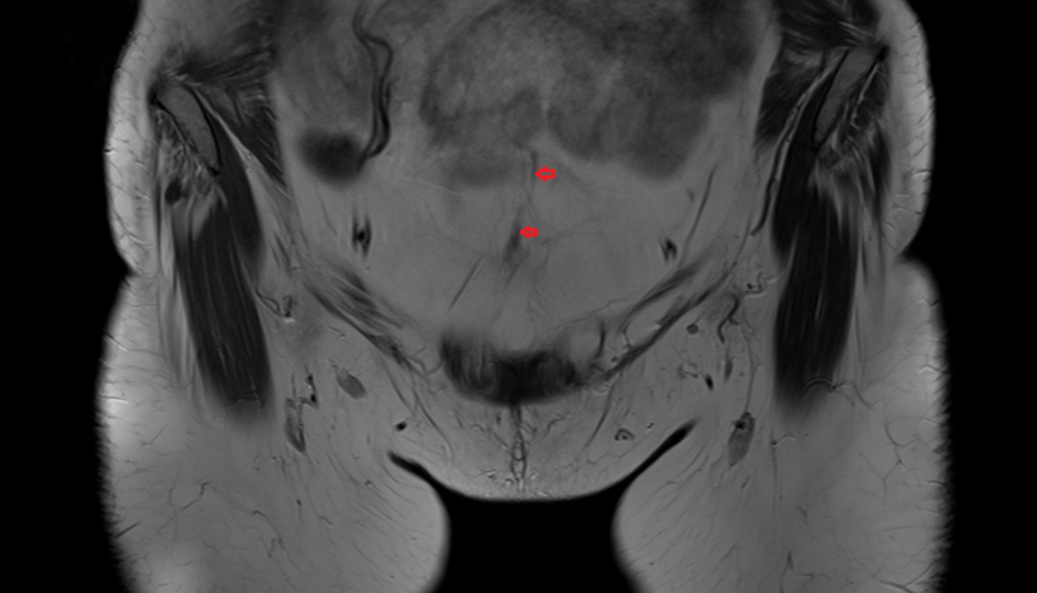 Median umbilical ligament  MRI  coronal  anatomy  image-img-00000-00000