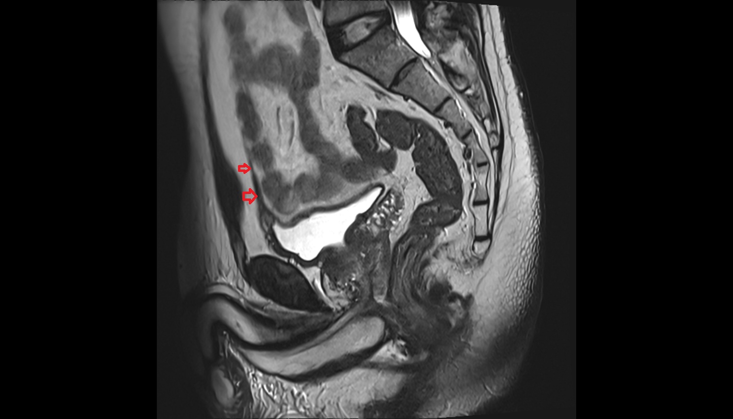 Median umbilical ligament  MRI  sagittal   anatomy  image-img-00000-00000