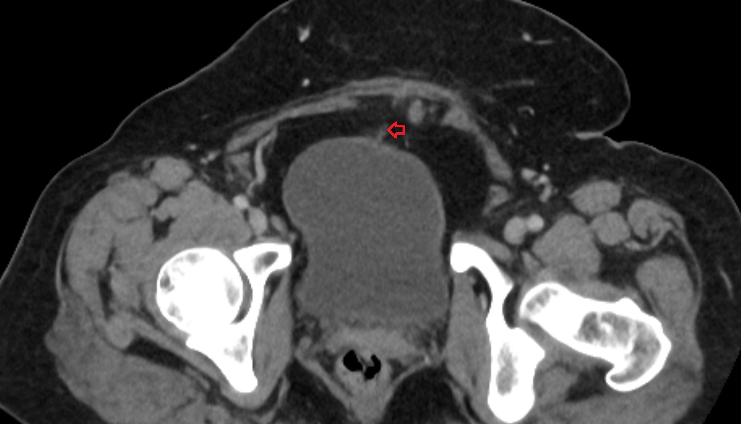 Median umbilical ligament  ct  axial  anatomy  image-img-00000-00000
