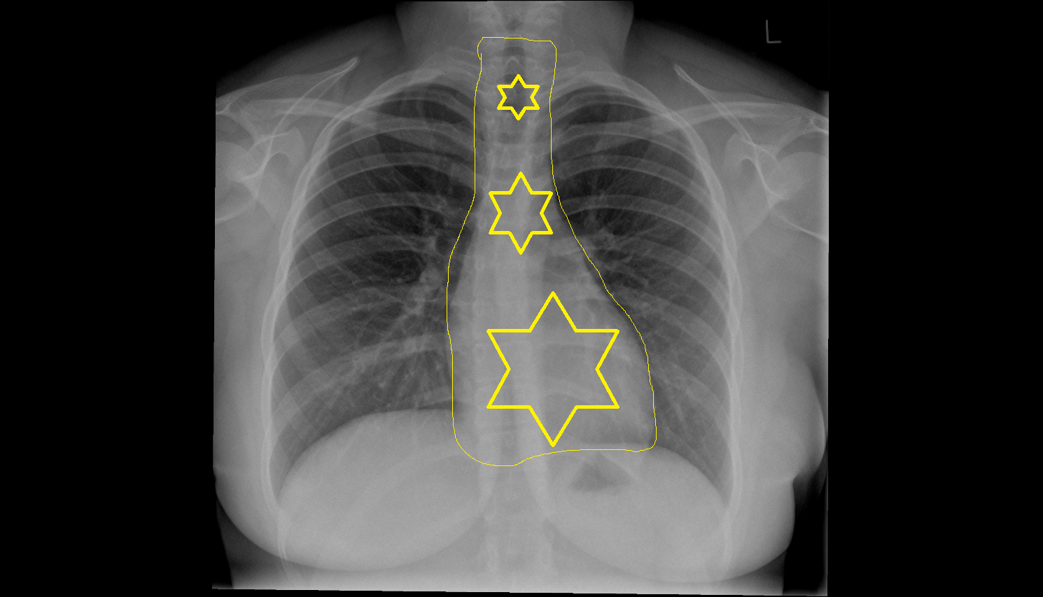 Mediastinum Anatomy, Location and Imaging Appearance CT anatomy image -img-00000-00000