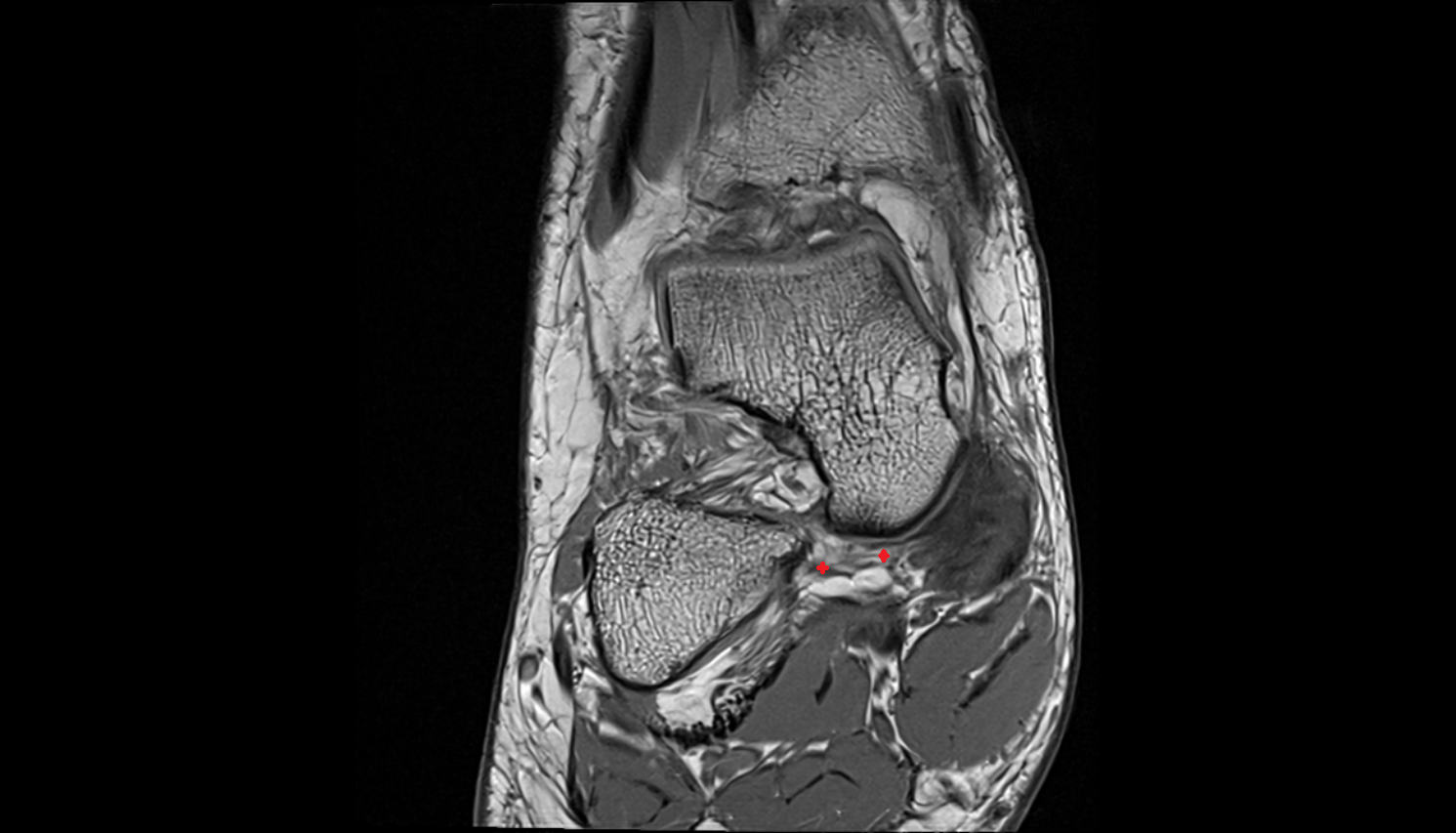 Medioplantar oblique calcaneonavicular ligament  coronal cross sectional anatomy 3T MRI AI enhanced radiology image-img-00000-00000_00001