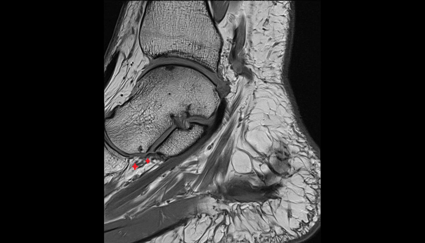 Medioplantar oblique calcaneonavicular ligament  sagittal cross sectional anatomy 3T MRI AI enhanced radiology image-img-00000-00000