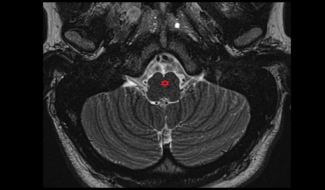 Medulla oblongata mri 3t  axial image