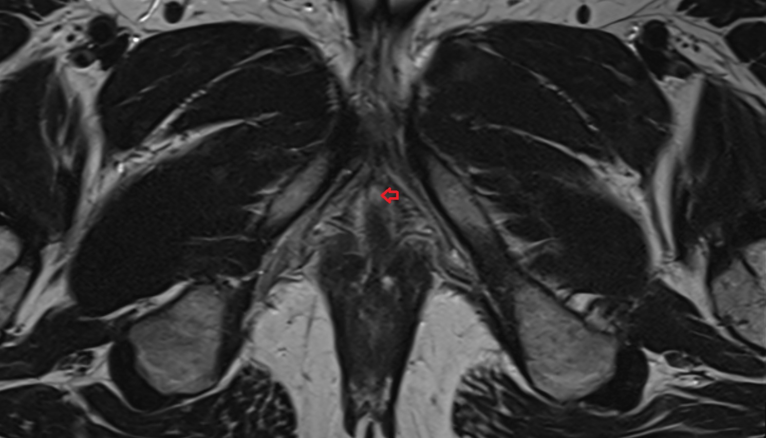 Membranous urethra  MRI  axial  anatomy  image-img-00000-00000