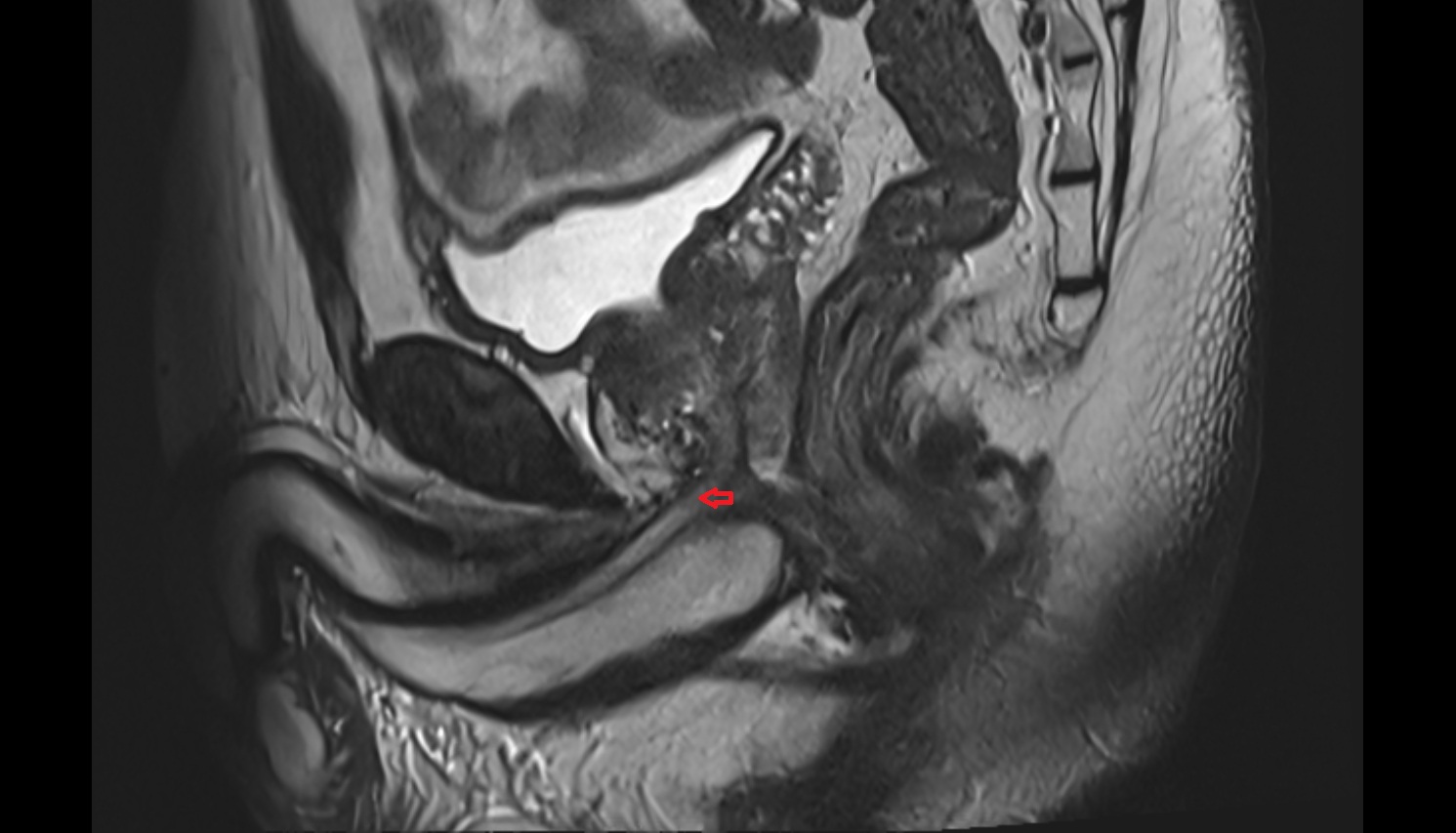 Membranous urethra  MRI  sagittal  anatomy  image-img-00000-00000