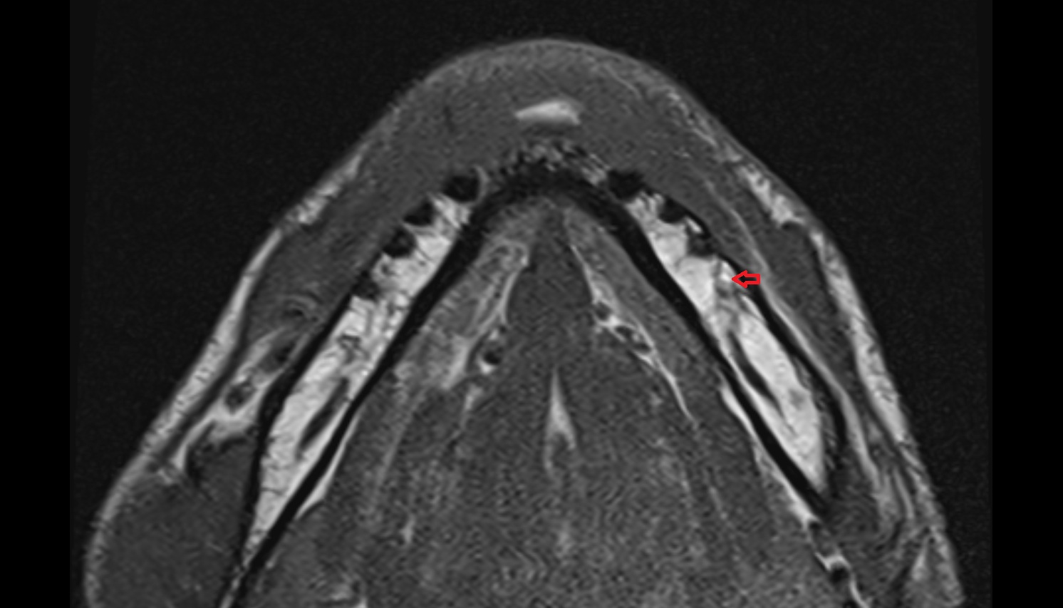 Mental foramen mri axial image -img-00000-00000