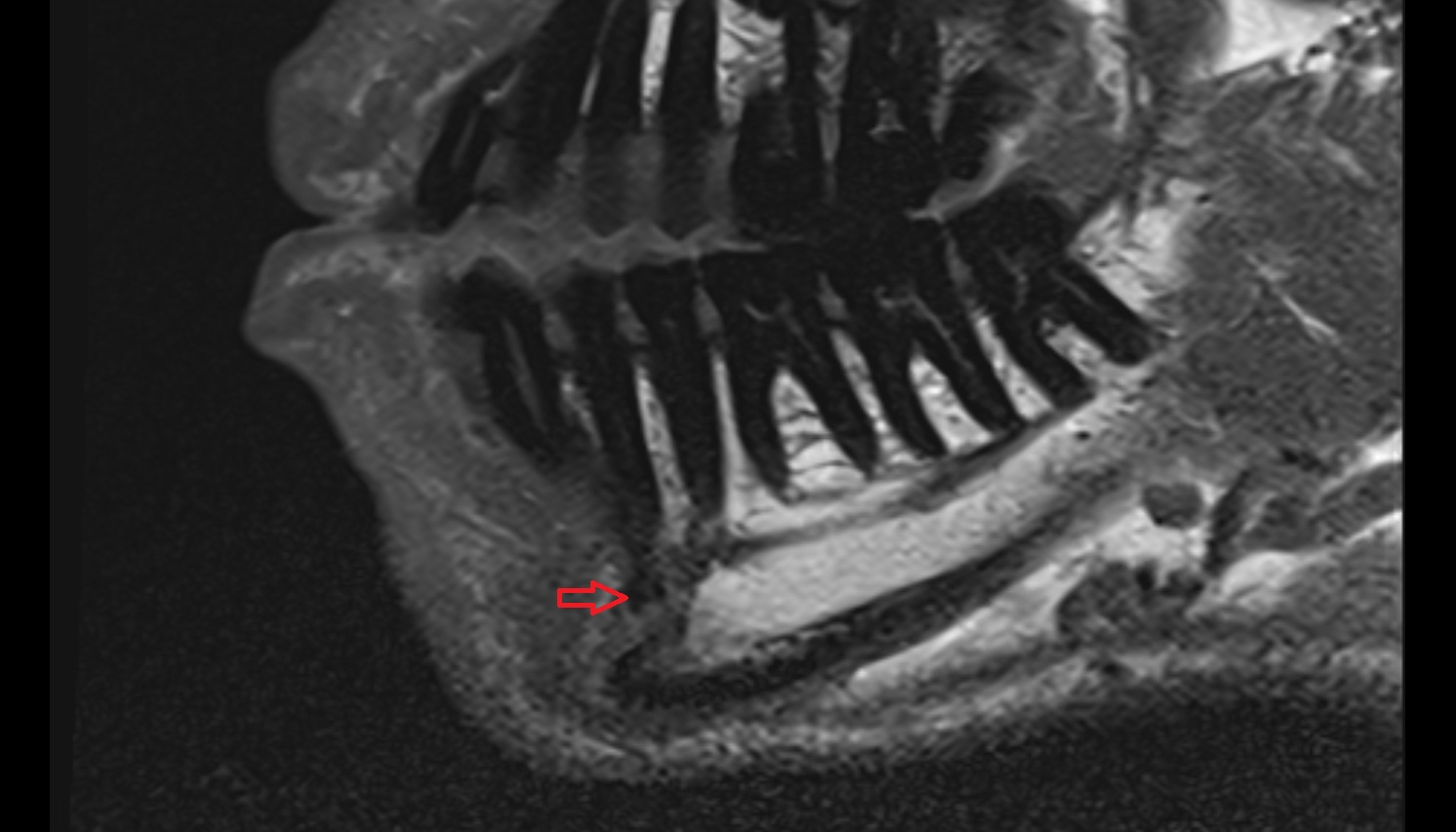 Mental foramen mri sag image -img-00000-00000