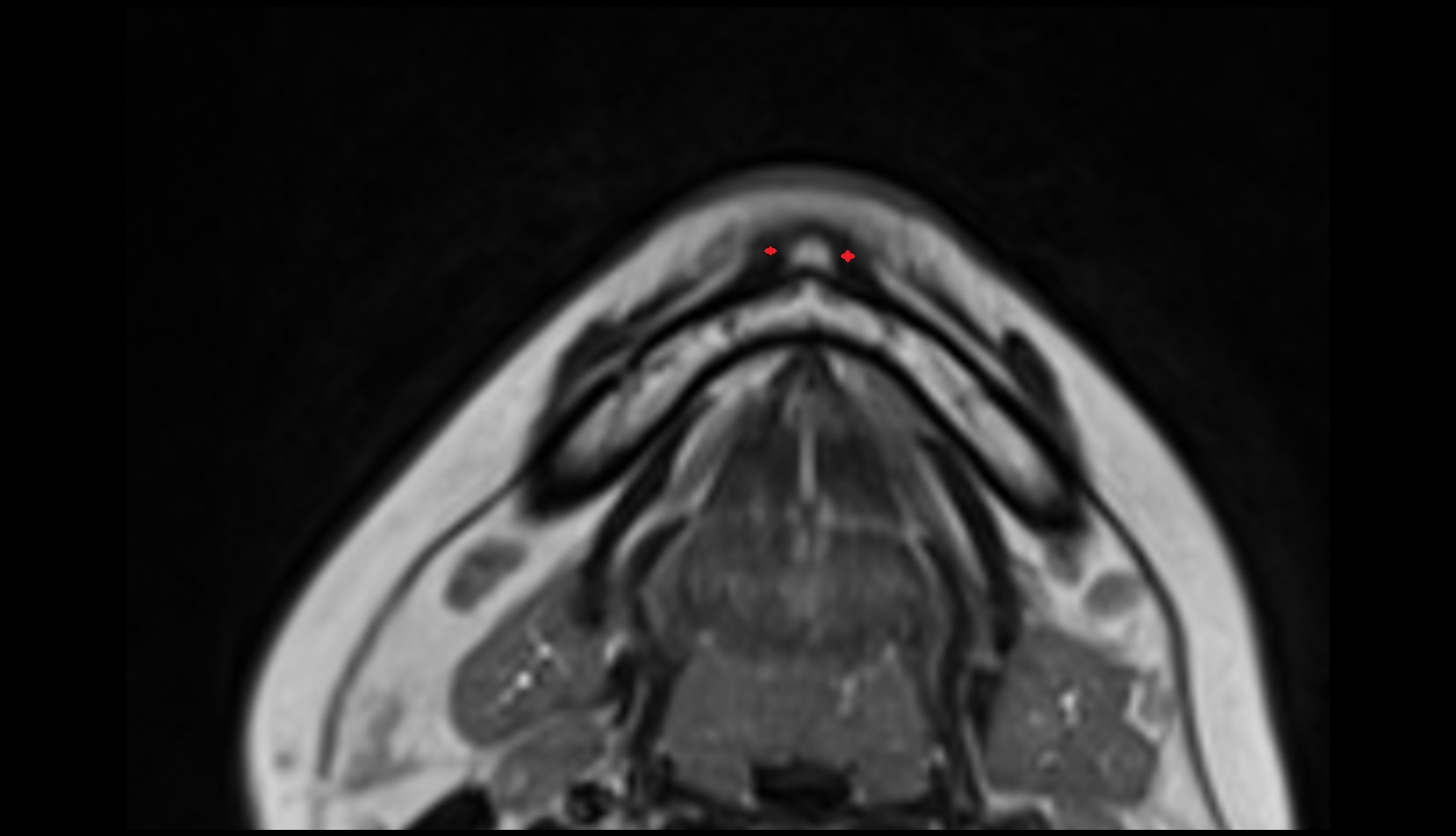 Mentalis muscle MRI axial image
