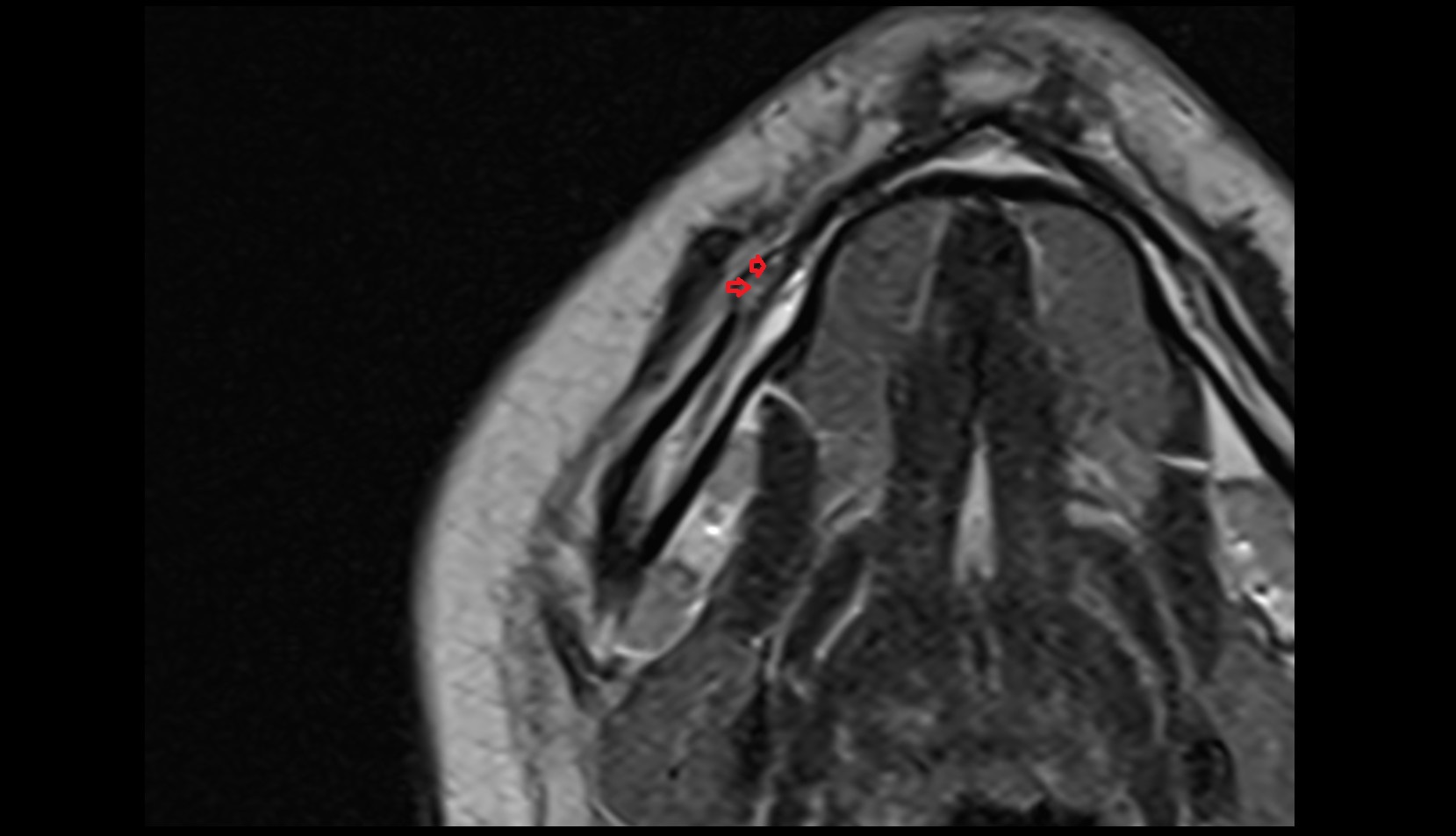 Mental nerve mri axial image