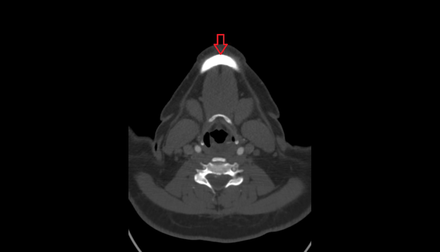 Mental protuberance  CT anatomy labelled image-img-00000-00000