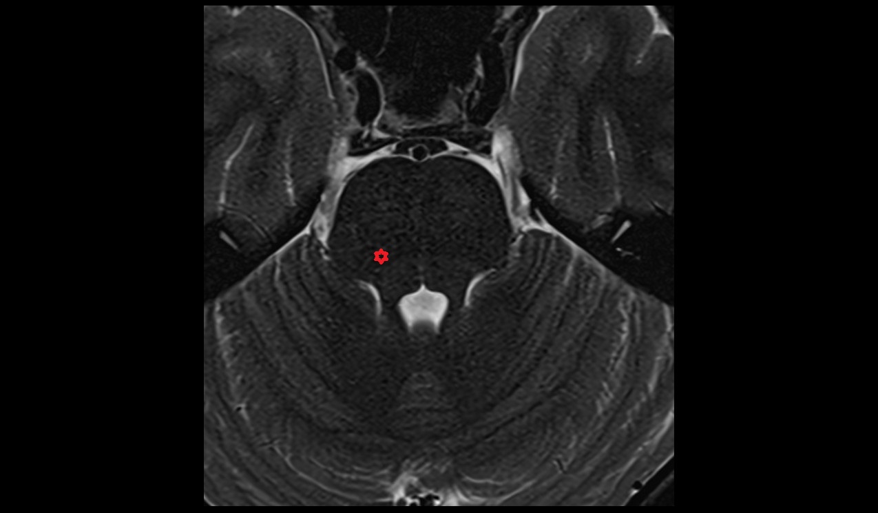 Mesencephalic nucleus of trigeminal nerve MRI 3T image