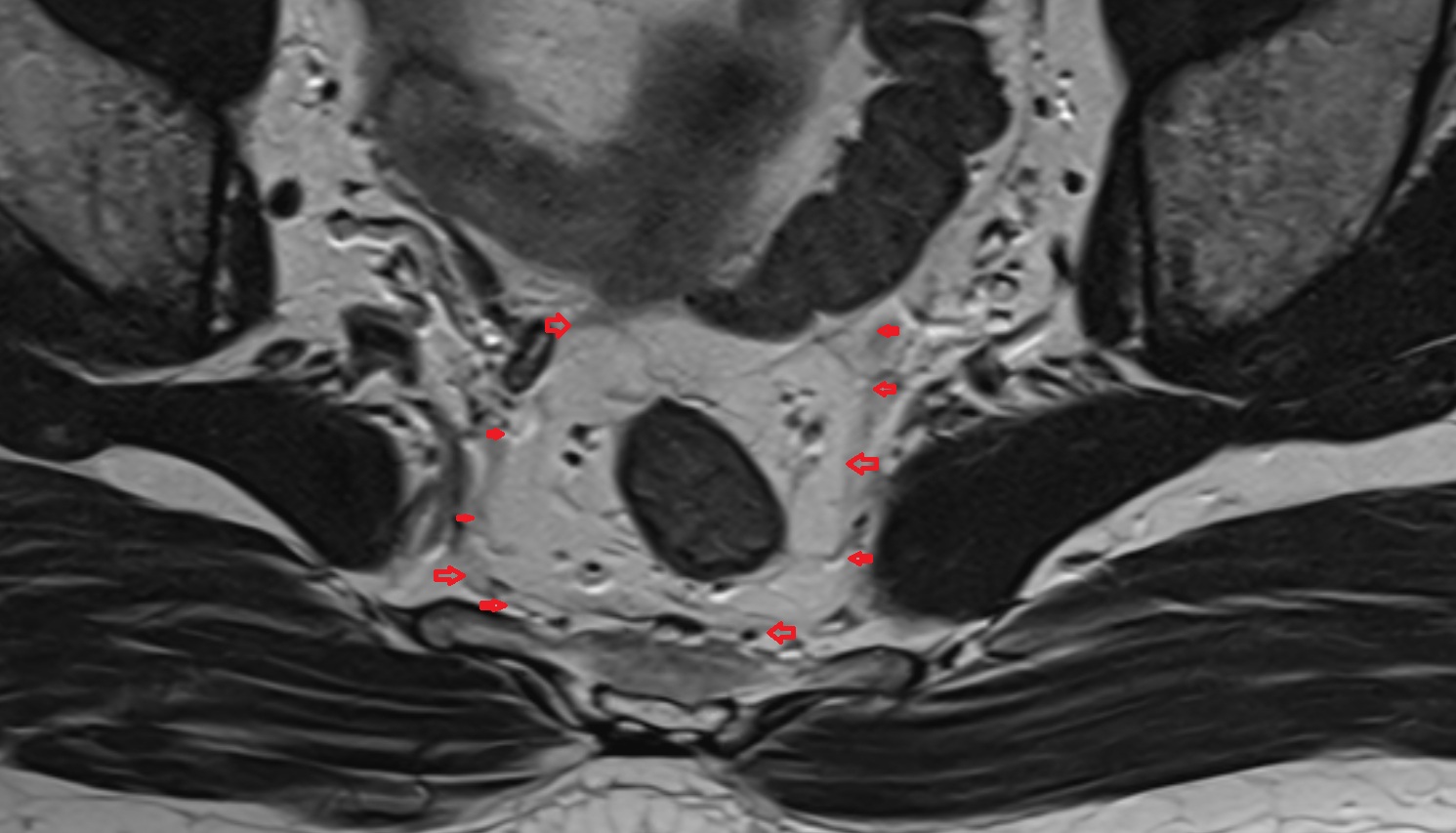 Mesorectal fascia  MRI  axial  anatomy  image-img-00000-00000