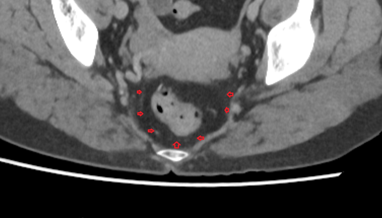 Mesorectal fascia  ct  axial  anatomy  image-img-00000-00000