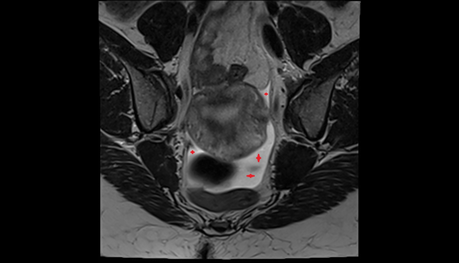 Mesorectal free fluid  mri coronal  anatomy  image-img-00000-00000