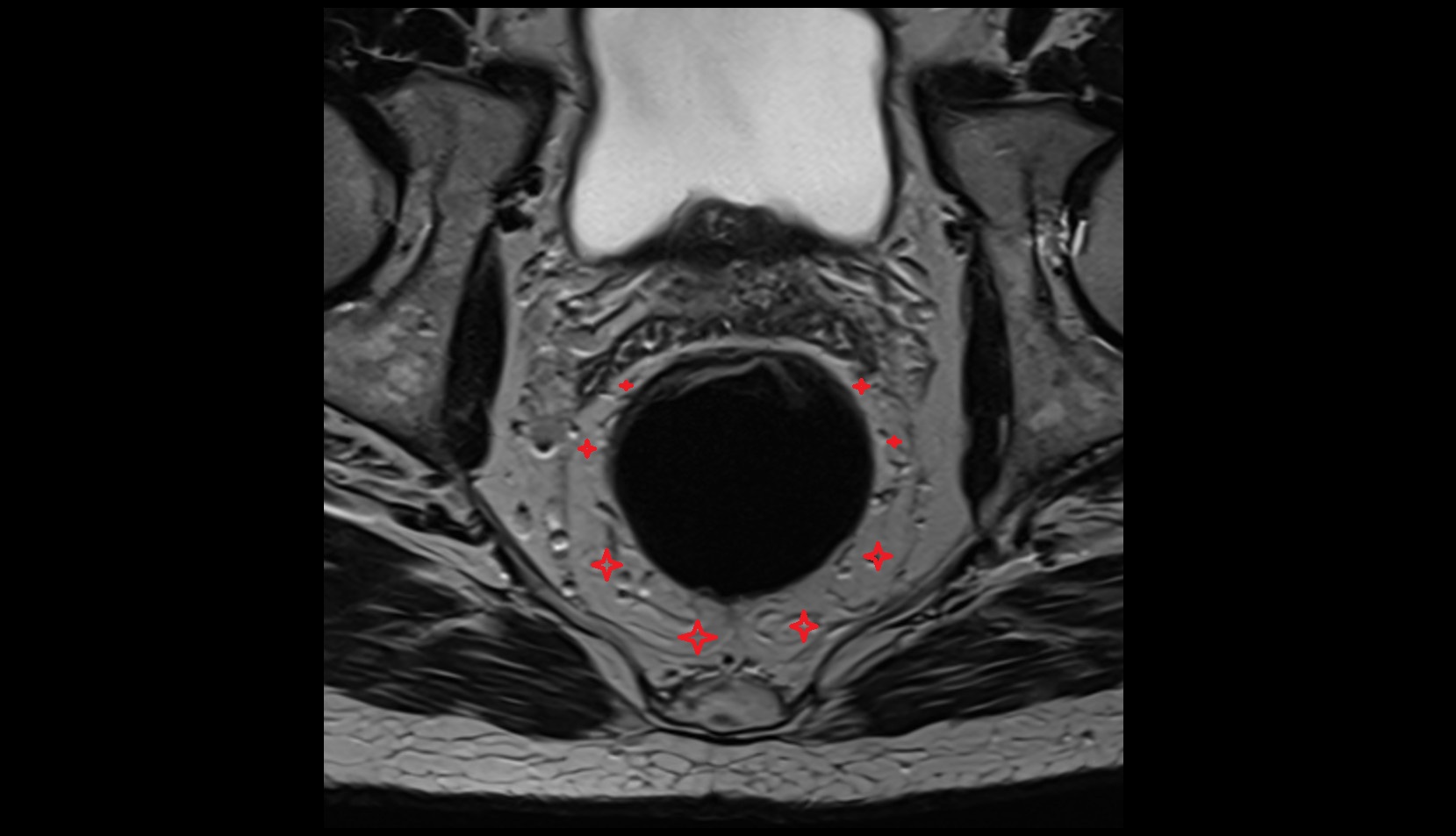 Mesorectum MRI axial image