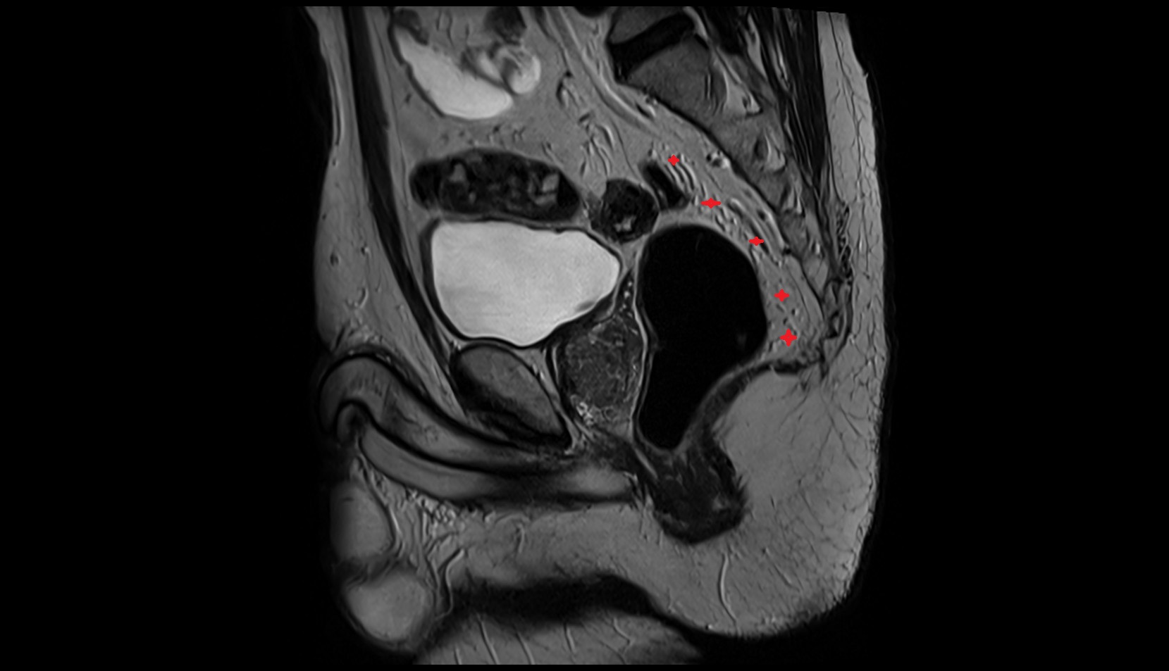Mesorectum MRI sagittal  image
