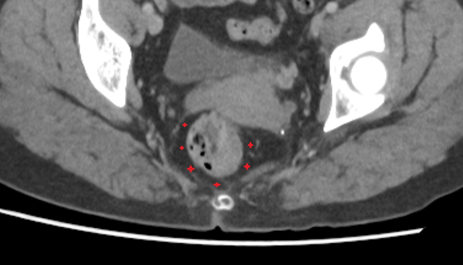Mesorectum  ct  axial  anatomy  image-img-00000-00000