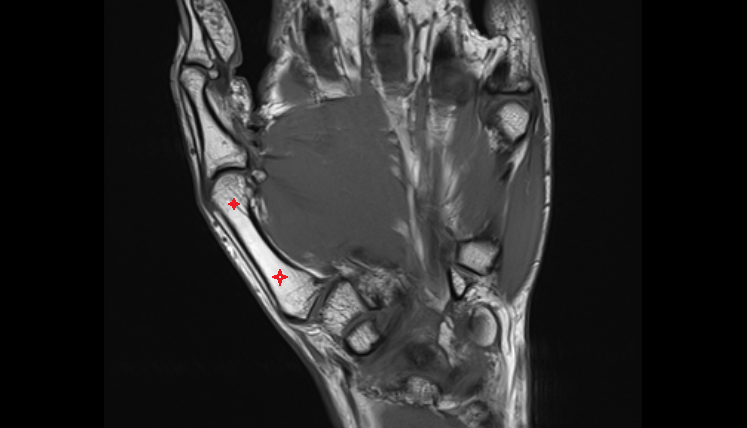 Metacarpal I (1st)  bone coronal cross sectional anatomy 3T MRI AI enhanced radiology image-img-00000-00000