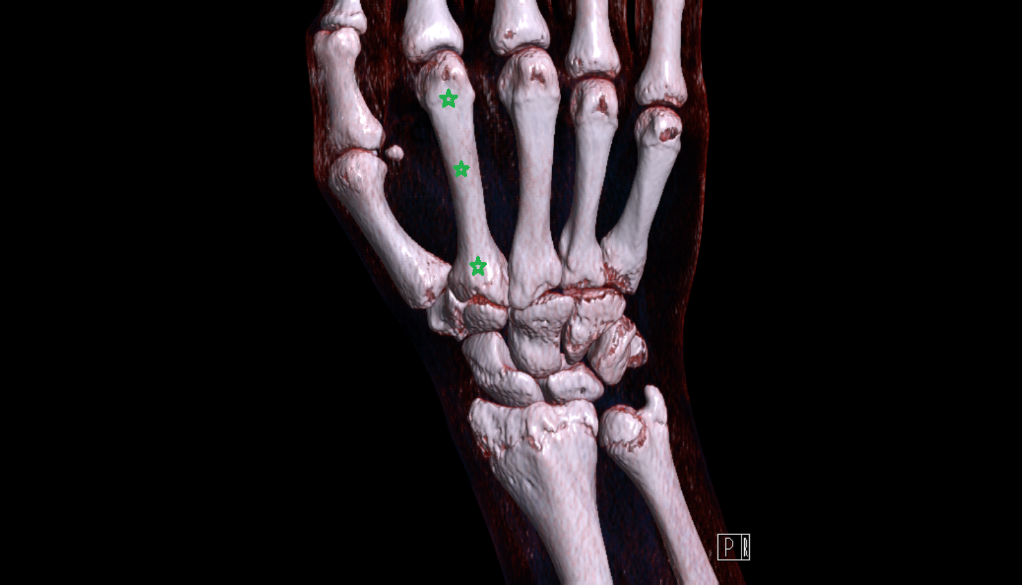 Metacarpal II (2nd)  bone bone CT 3D VRT image -img-00000-00000_00001