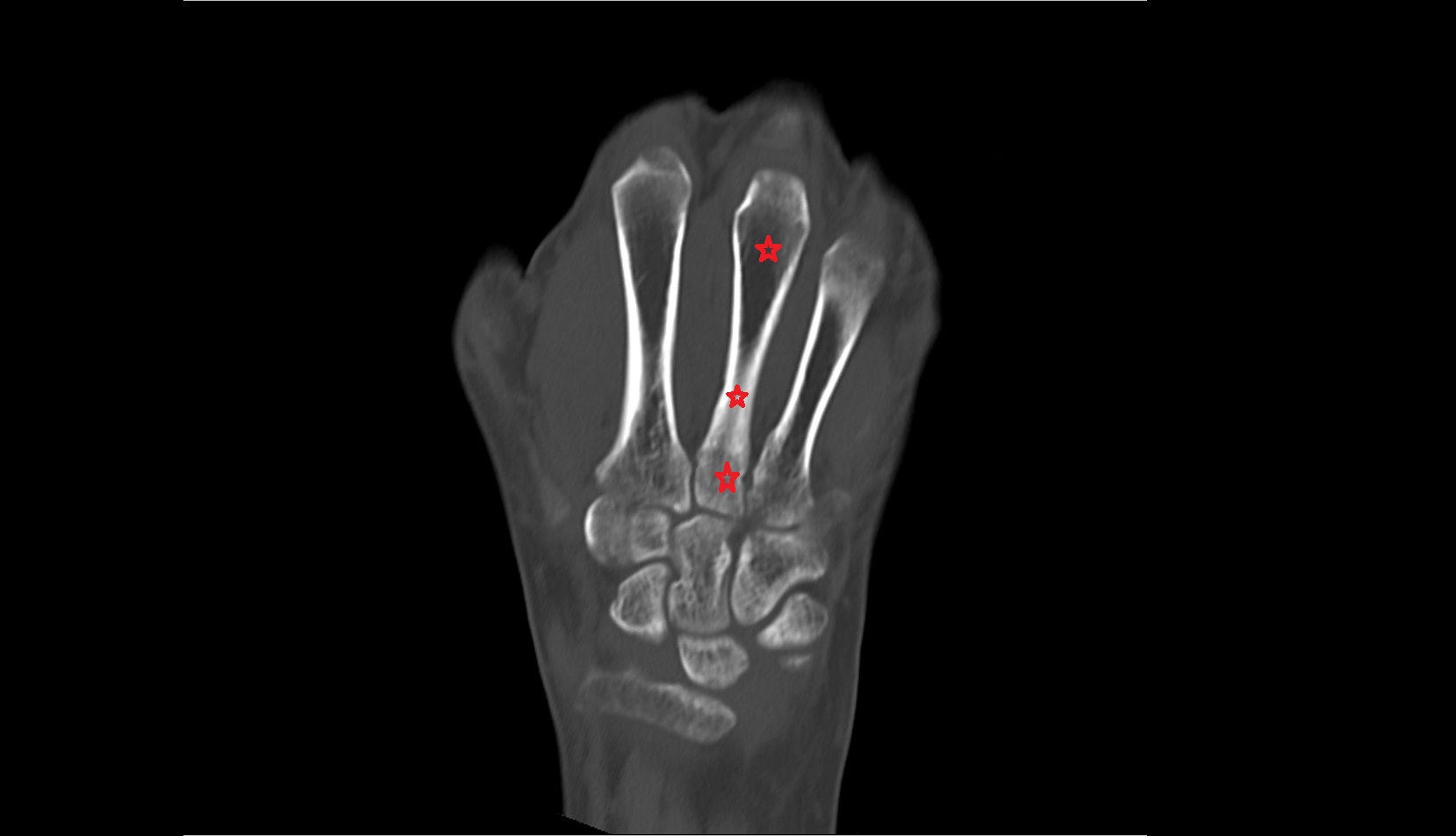 Metacarpal III (Third Metacarpal Bone) ct coronal image